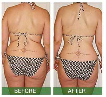 Women Body before and after